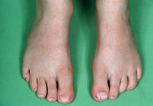 Der Pilz an den Beinen