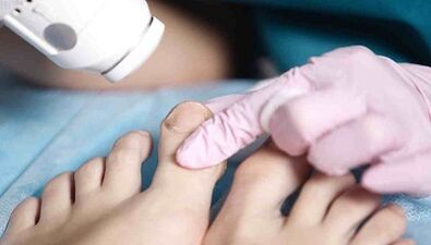 Hardwarebehandlung von Pilzen an den Beinen