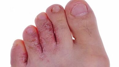 Typen und Phasen der Entwicklung von Pilzen an den Beinen