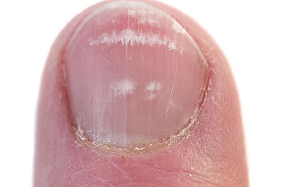 Die ersten Anzeichen und Symptome