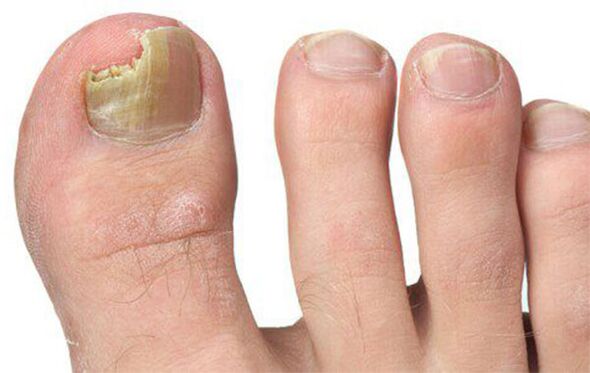 Verschiedene Formen des Pilzes