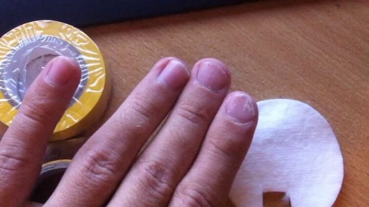 Nagelpilz und seine Behandlung mit Volksheilmitteln