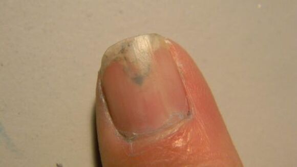 Symptome von Nagelpilz